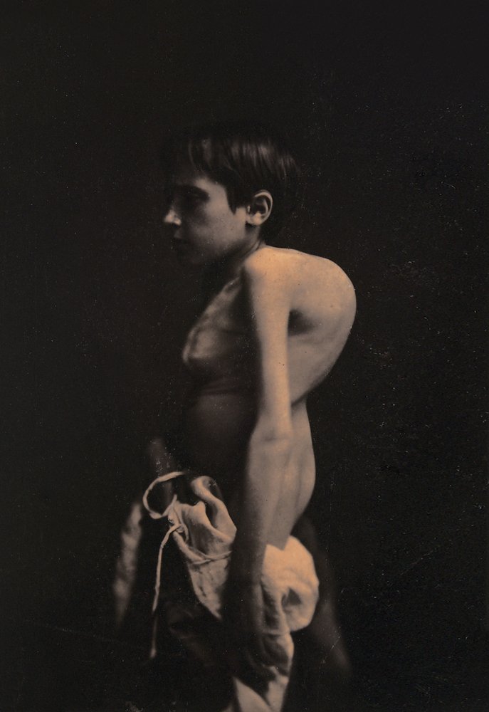 Portret van een gebochelde jongen door Guillaume-Benjamin-Armand Duchenne de Boulogne