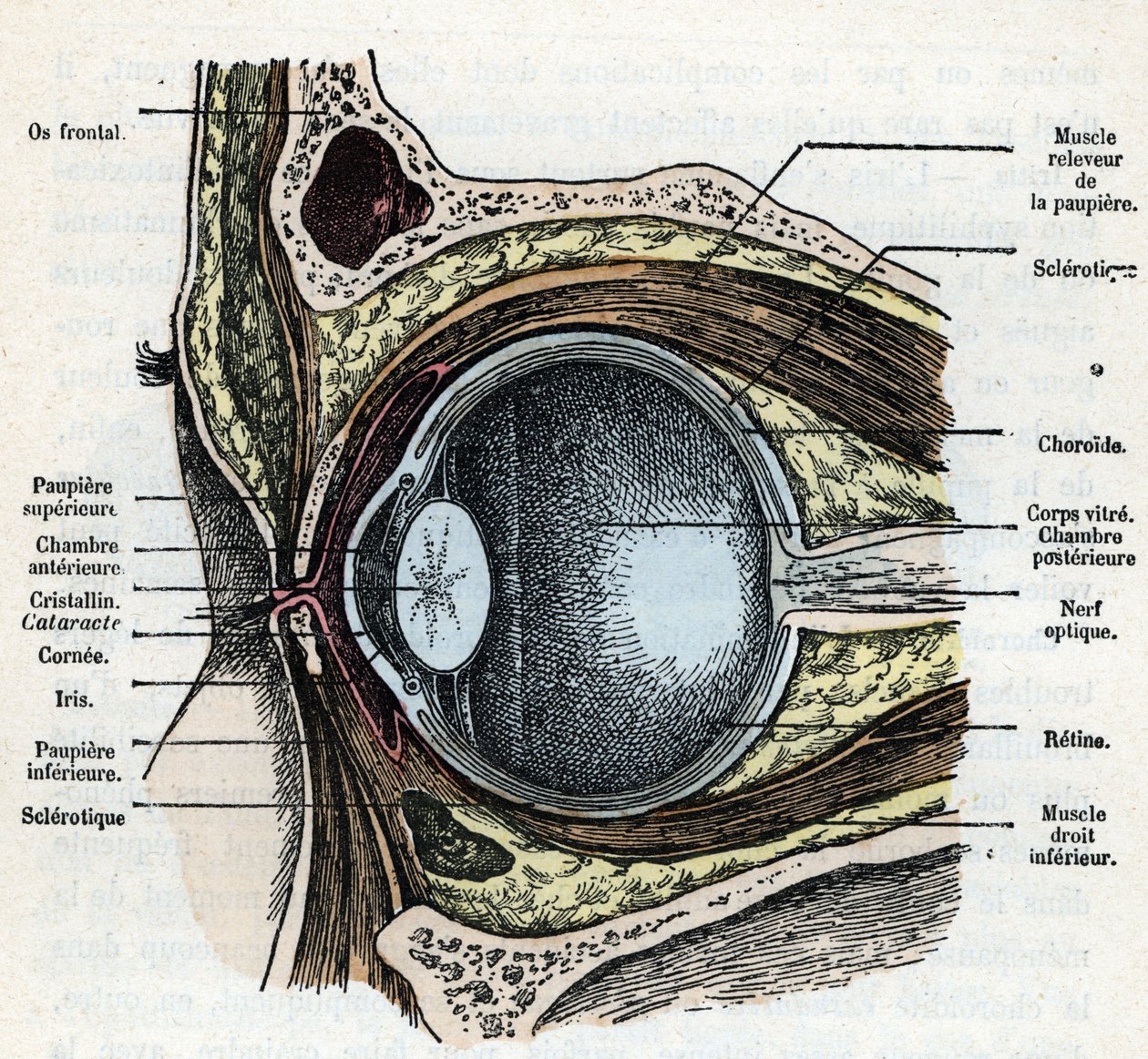 Verticale doorsnede van een oogbal met cataract Gravure uit 