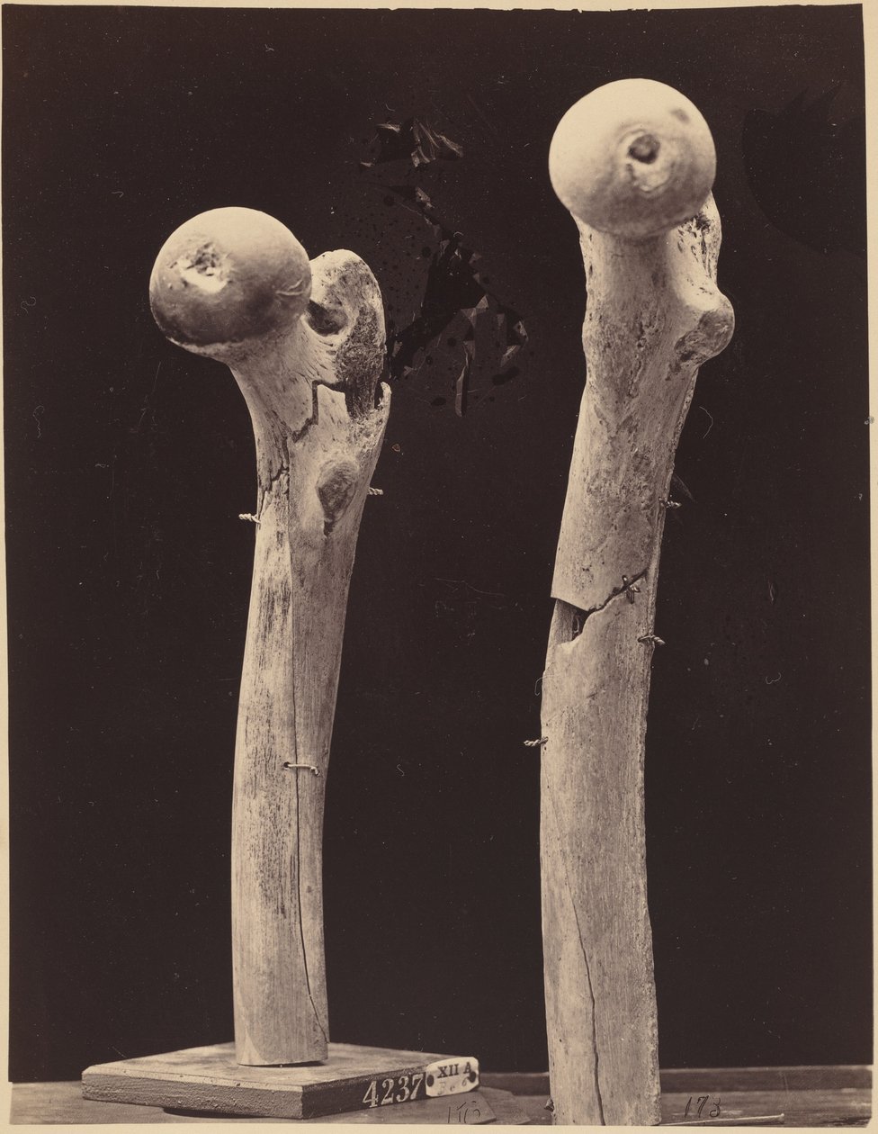 Exemplaren van schotbreuken van het dijbeen, c. 1867 (foto) door American Photographer