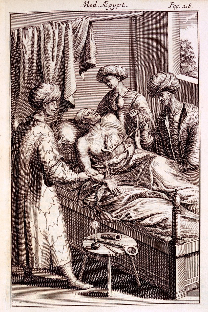 Illustratie van moxibustie uit Medicina Aegyptorum door Prospero Alpinus, 1745 door American School