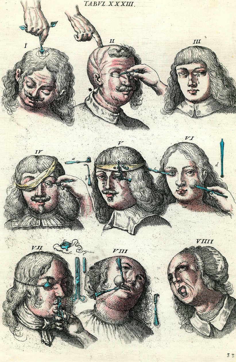 Chirurgie in de 18e eeuw: Trepanatie en operatie van het oog en gezicht. Gravure in 