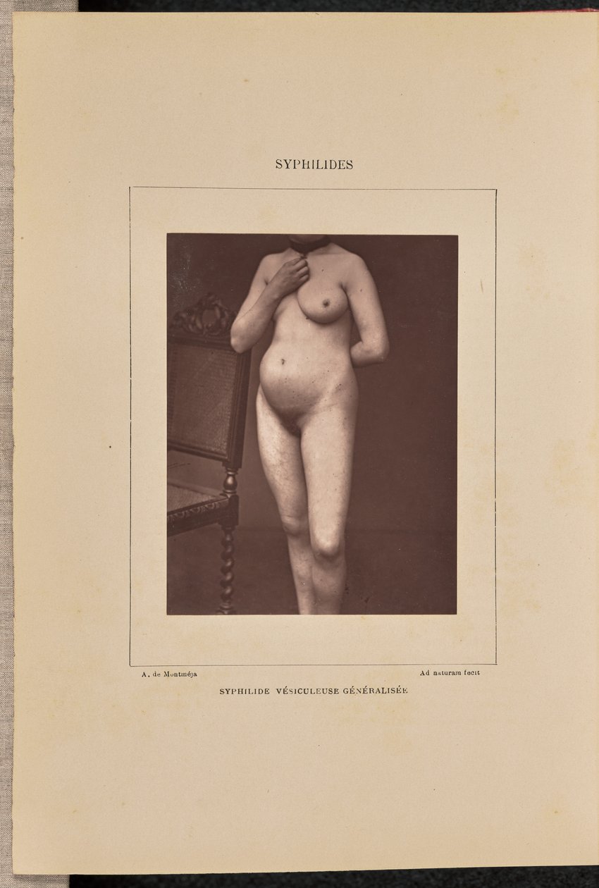 Gegeneraliseerde vesiculaire syfilis door Arthur de Montmeja