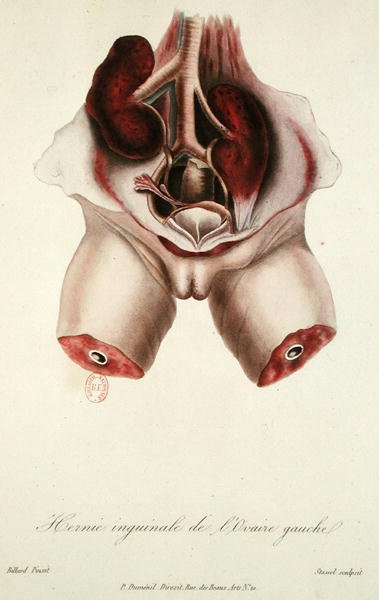 Inguinale hernia van de linker eierstok, uit 