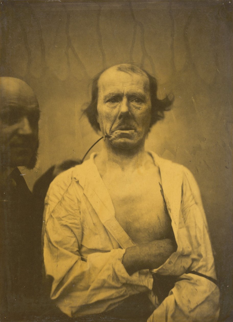 Een ontspannen uitdrukking links, Walging rechts, 1854-1856, gedrukt 1862 door Duchenne de Boulogne