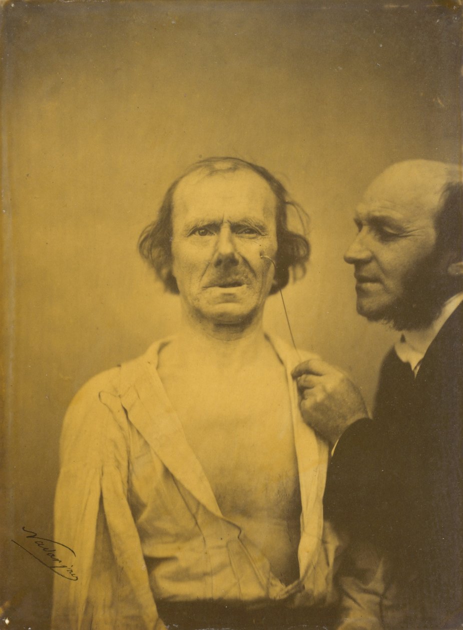 Huilen, tranen van medelijden links, Ontspannen gezicht rechts, 1854-1856, gedrukt 1862 door Duchenne de Boulogne