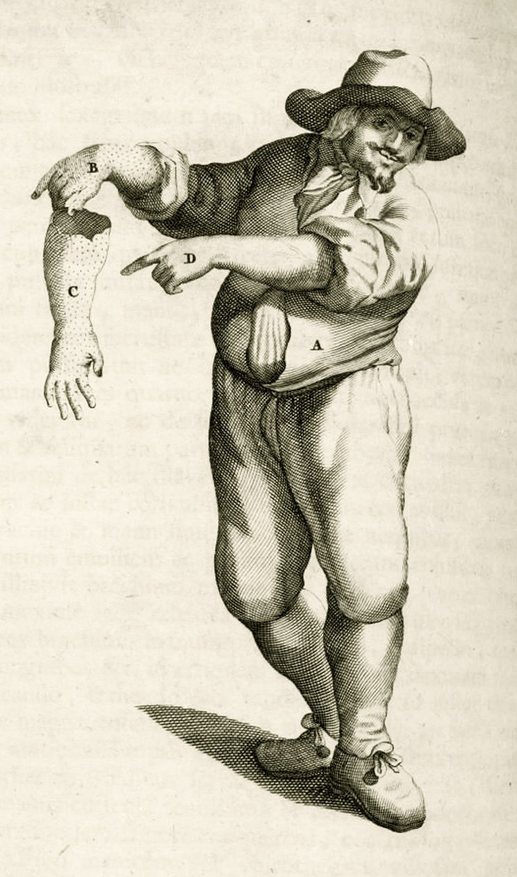 Verwijderen van dode huid met puisten, uit Exercitationes Practicae circa Medendi Methodum door Frederik Dekkers, 1694 door Dutch School