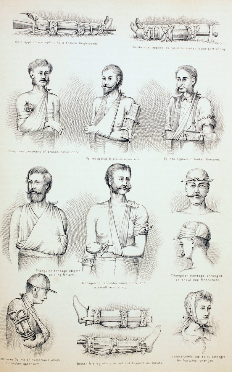Tijdelijke Behandeling van Breuken, ca. 1890 door English School