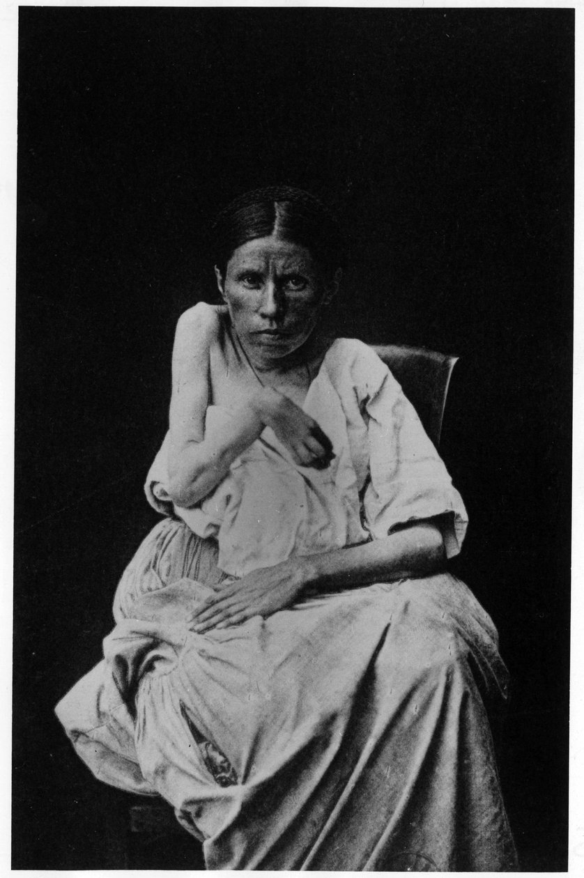 Foto van een patiënt met hemiplegische epilepsie, in "fotografische iconografie van de Salpetrière, Bourneville en P. Regnard, Parijs" door French Photographer