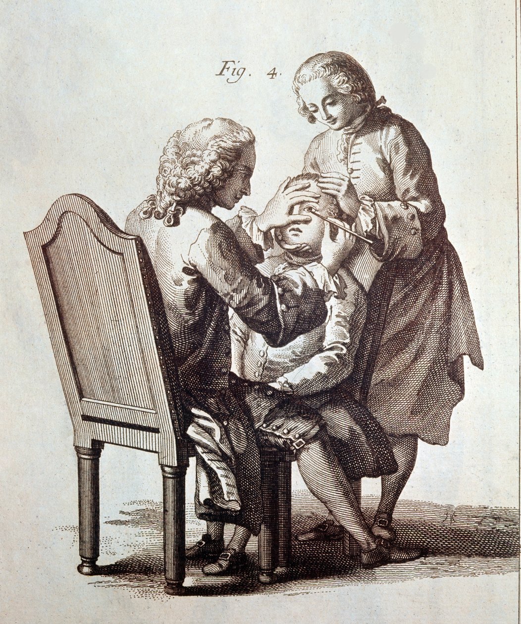 Een arts die een cataractpatiënt opereert, illustratie uit de Medische Encyclopedie van Denis Diderot en Jean le Rond d