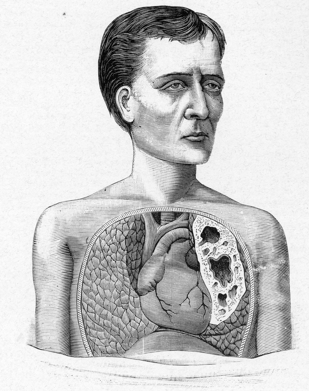 Voorstelling van een persoon met grotten, complicatie van tuberculose (gravure) door French School
