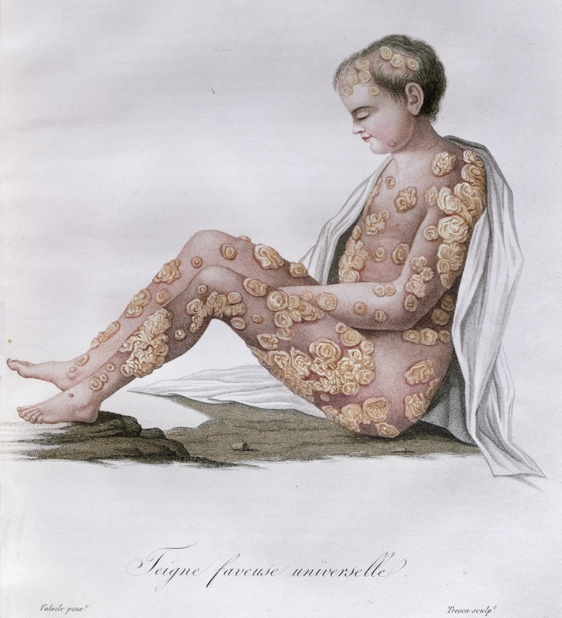 Ringworm, uit een boek door Baron Jean Louis Alibert, 1838 door French School