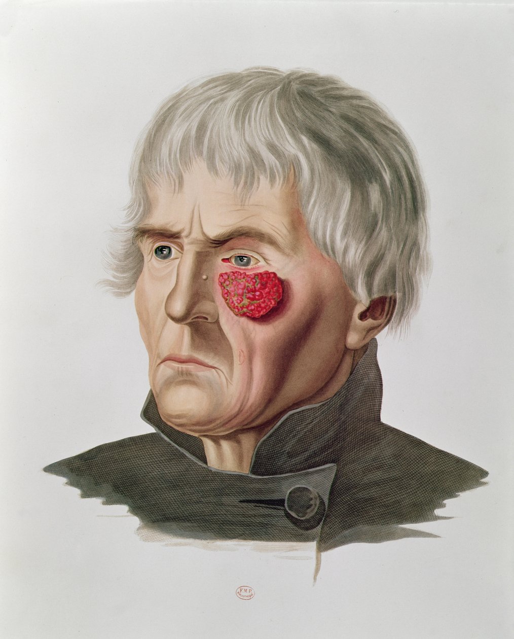 Huidaandoening voor een operatie, uit Selecta Praxis Medico-Chirurgica door Alexander Auvert, Parijs, 1856 door French School