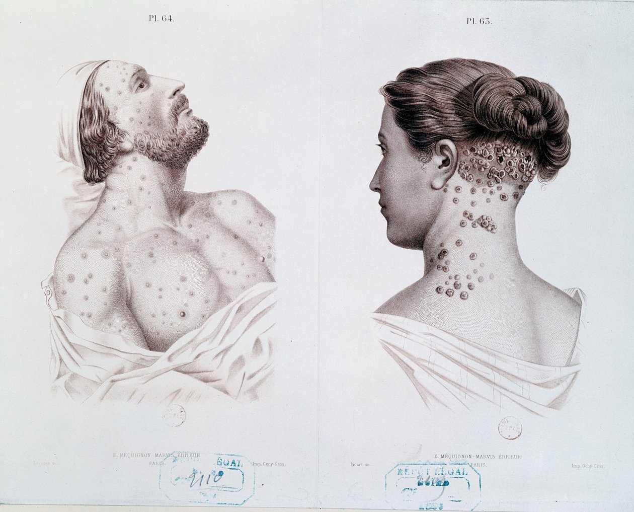 Symptomen van syfilis bij mannen en vrouwen, uit een medisch boek, c.1850-60 door French School