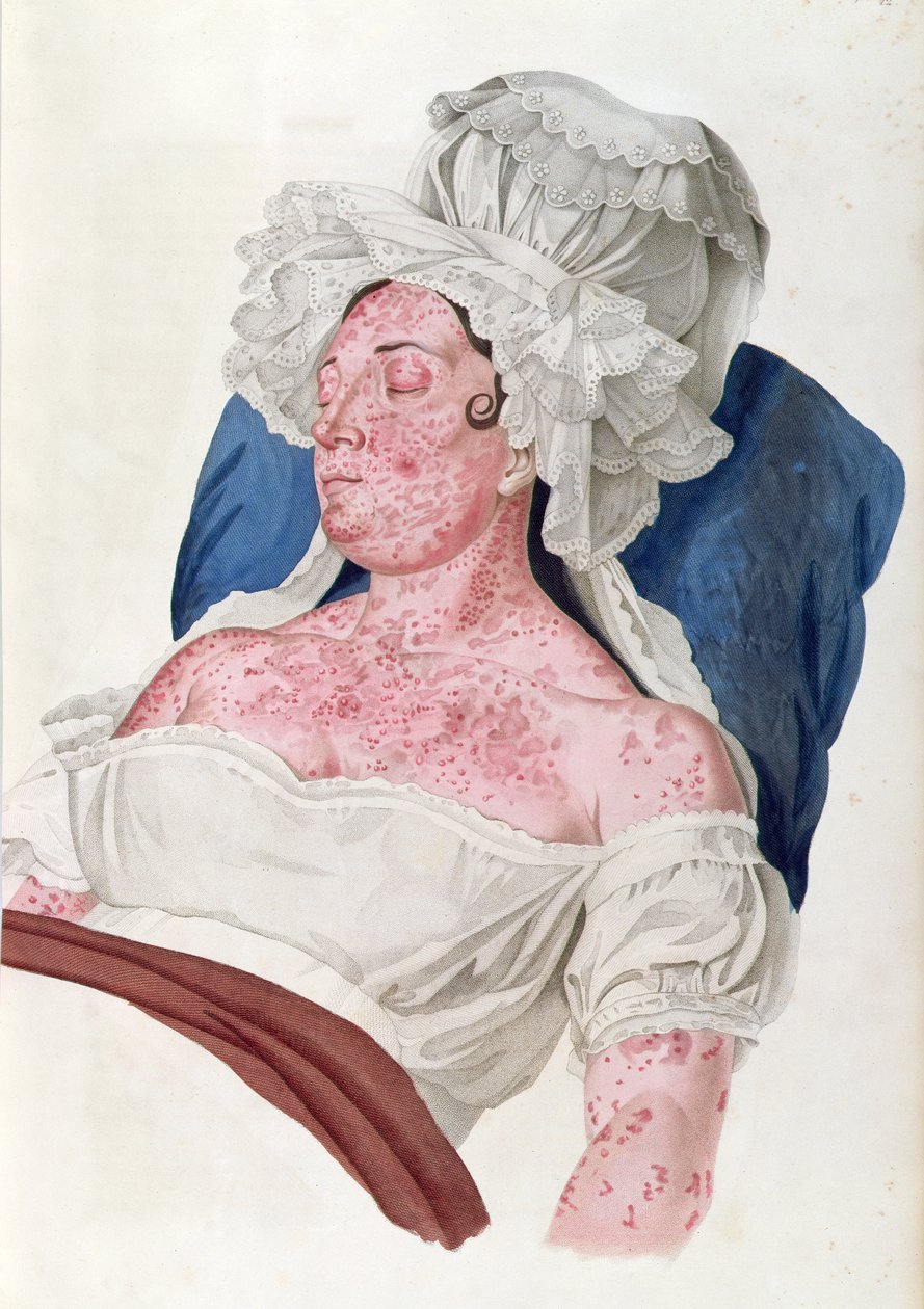 Vrouw met roodvonk, uit een boek van Baron Jean Louis Alibert (1768-1837) gegraveerd door Choupard, 1833 door French School