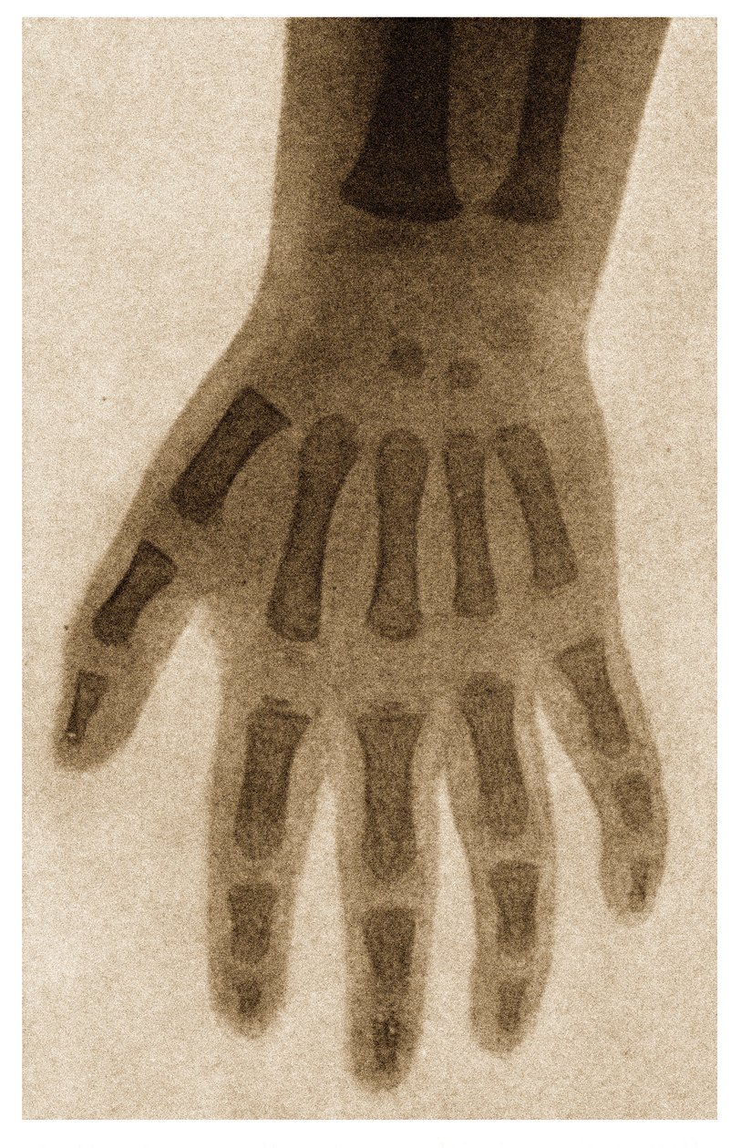 Röntgenfoto van een Kinderhand, ca. 1890 door German School