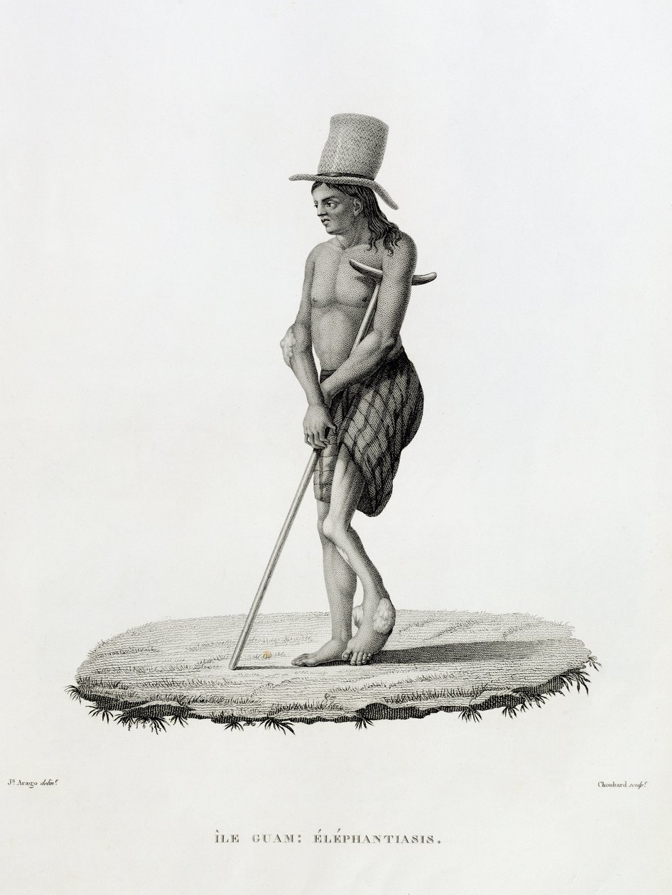 Guam: Een Man met Elephantiasis, uit 