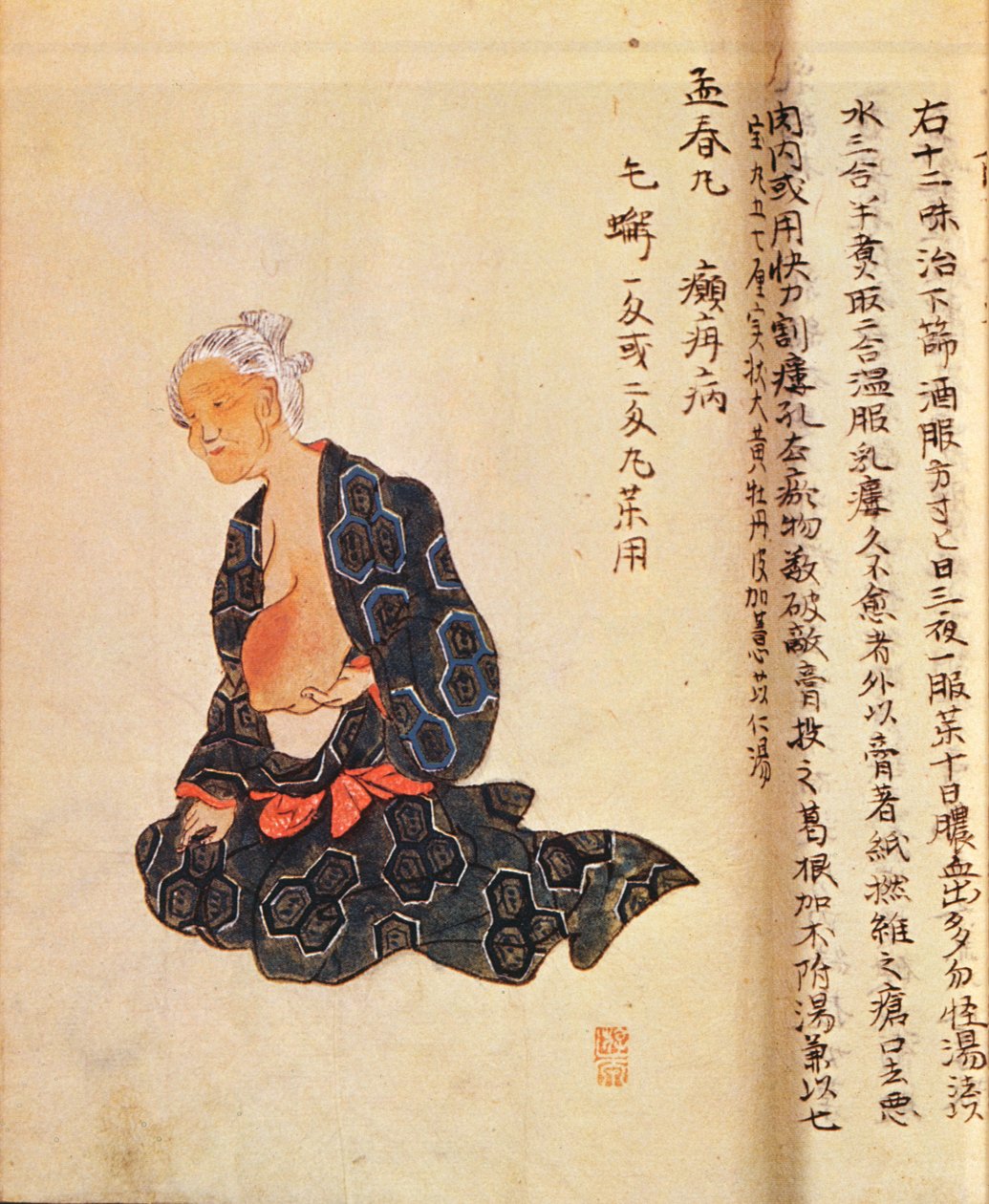 De eerste chirurgische behandeling van borstkanker uitgevoerd onder algemene verdoving door Seishu Hanaoka in 1804 door Japanese School