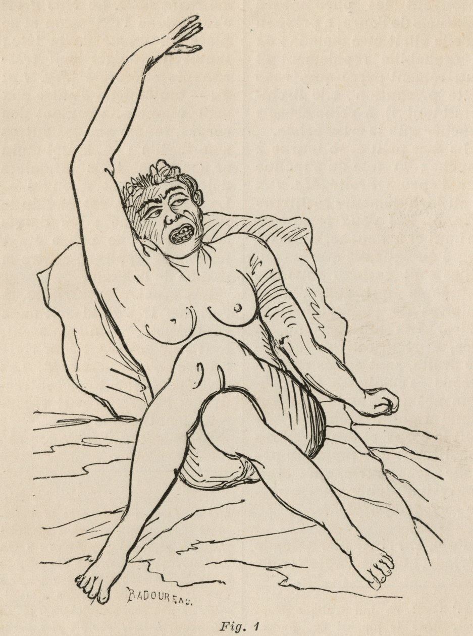 Hysterische epilepsie, aanval, vervormingen, fig. 1 uit 