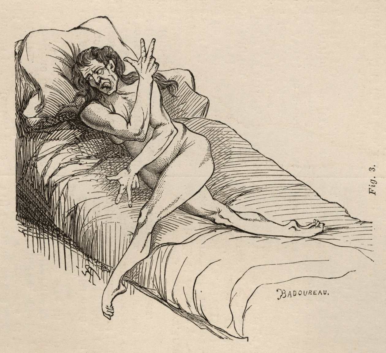Hysterische epilepsie, aanval, vervormingen, fig. 3 uit 