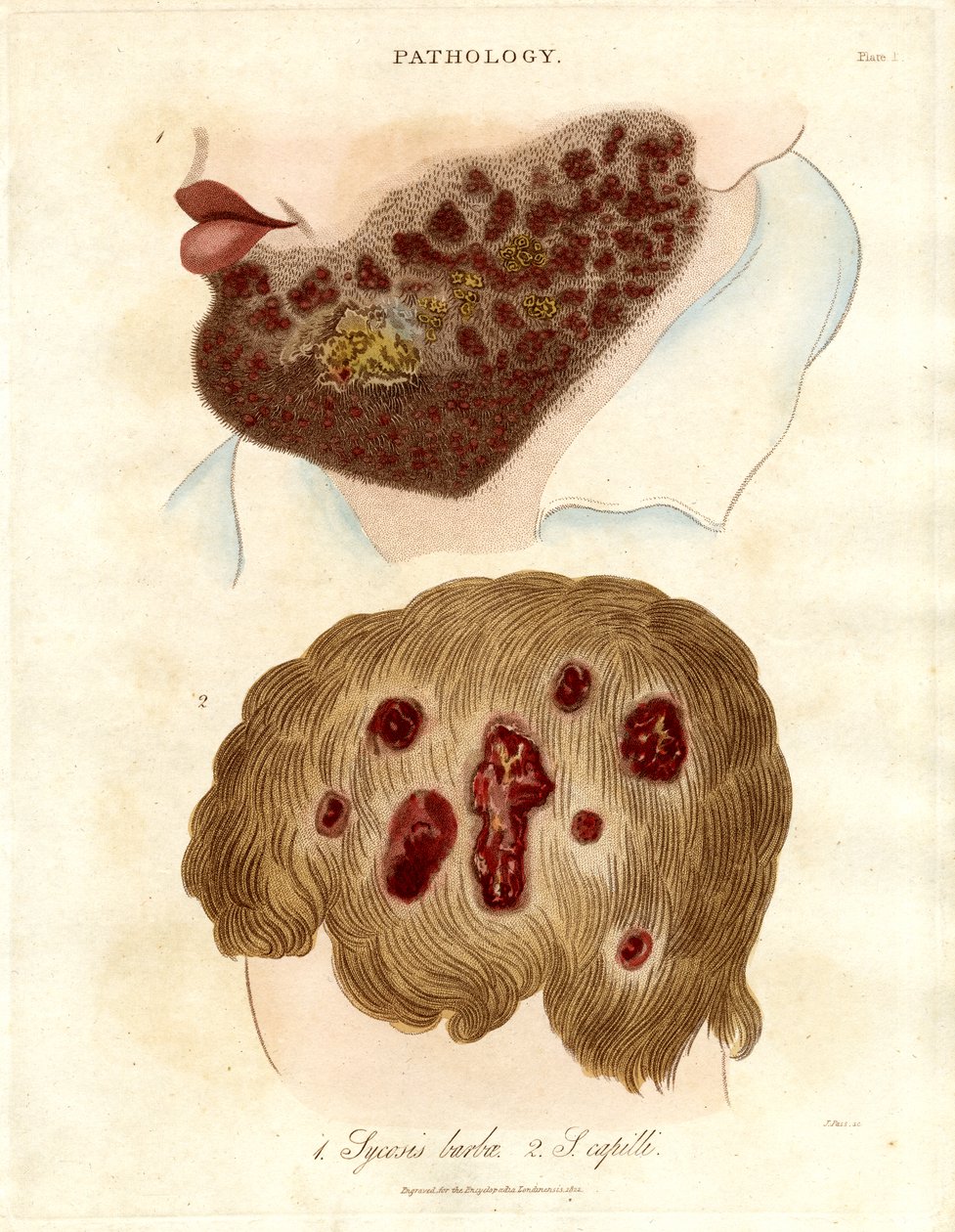 Pathologische illustratie van Sycosis barbae en Sycosis capilli door John Pass