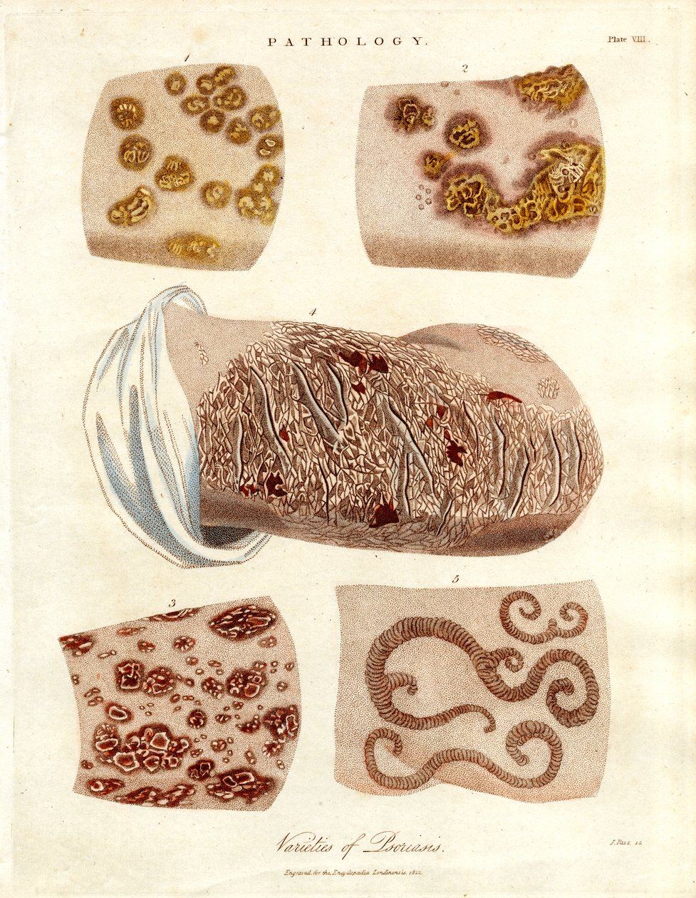 Pathologische huidveranderingen: Verscheidenheden van psoriasis door John Pass