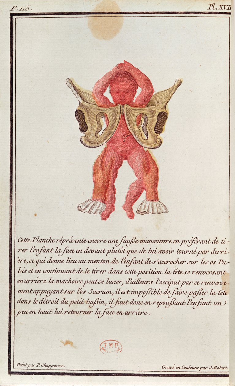 Dwarsdoorsnede diagram van een baby die aan de benen uit de baarmoeder wordt getrokken, uit een boek van Madame Angelique Le Boursier du Coudray, gegraveerd door J. Robert, 1783 door P. Chapparre