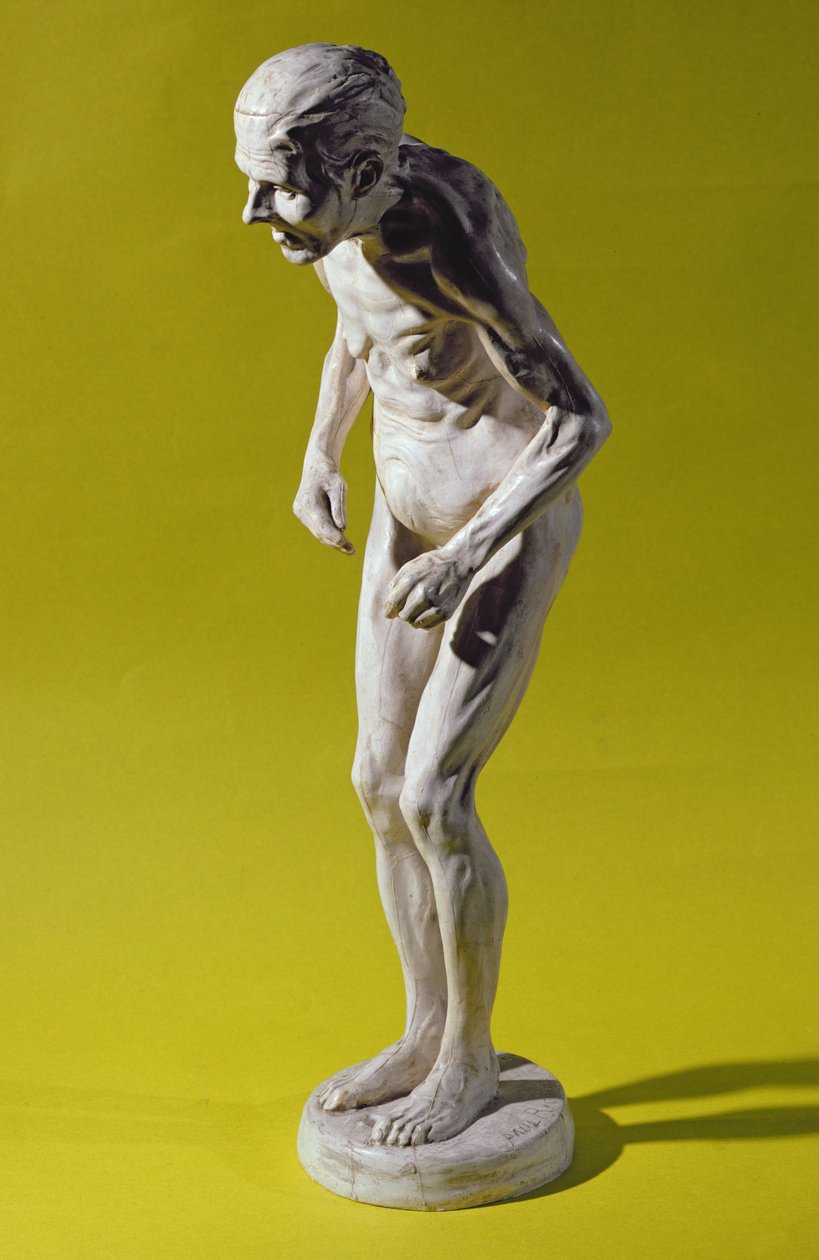 Beeld van een vrouw met de ziekte van Parkinson door Paul Marie Louis Pierre Richer
