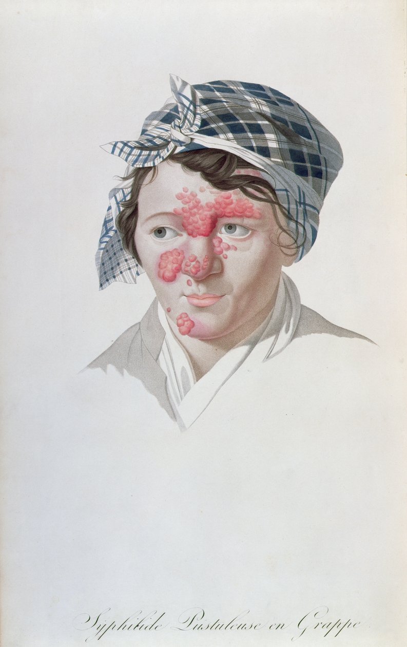 Syfilitische clusterpuisten, uit een boek van Baron Jean Louis Alibert, 1838 door Salvadore Tresca