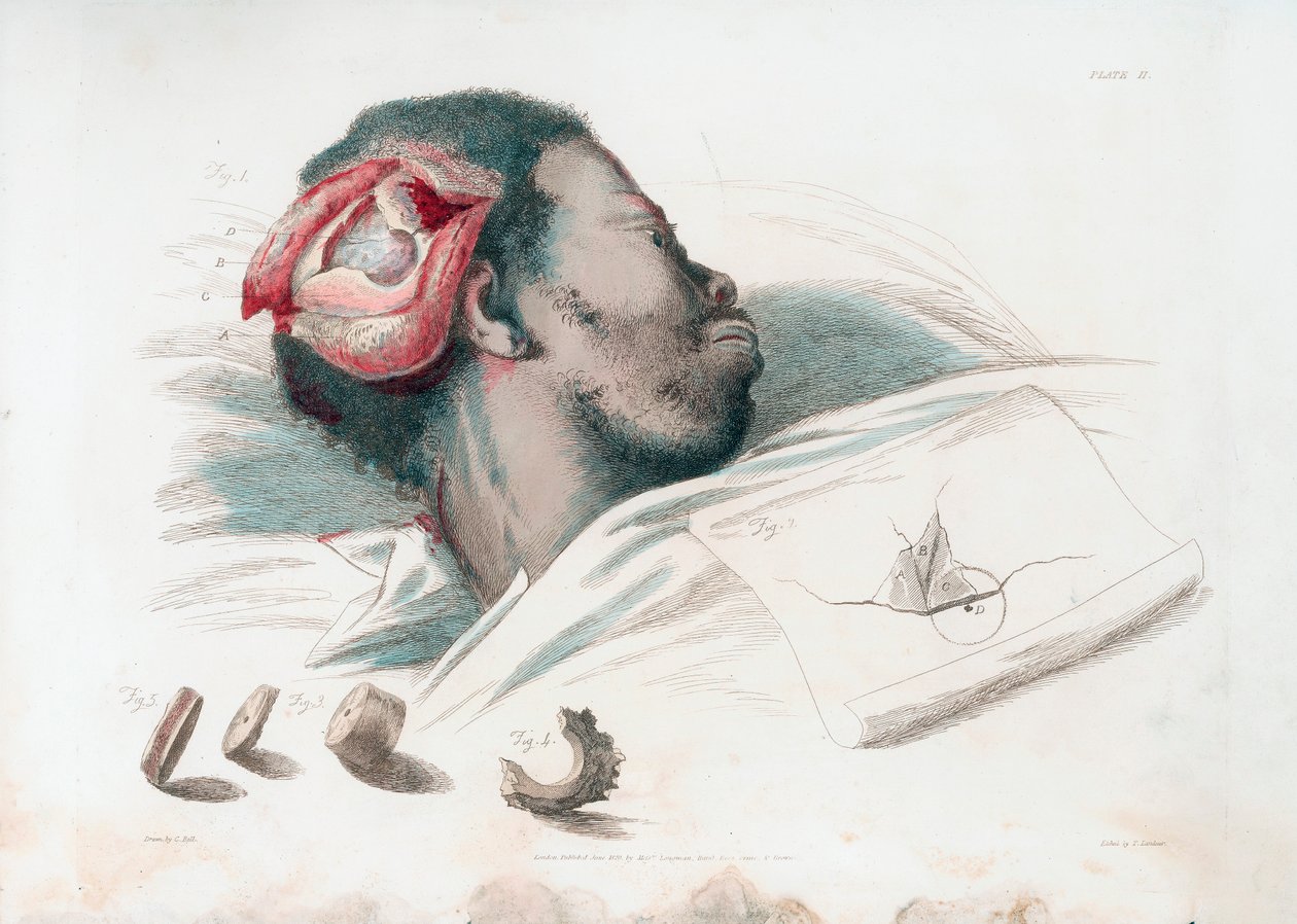 Zicht op wond in schedel na trepanatie en verwijdering van verbrijzeld botstuk linksonder, 1821 door Thomas Landseer