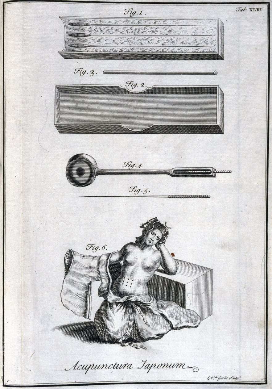 Alternatieve geneeskunde: plaat met acupunctuurnaalden en hun toepassing, gravure uit 