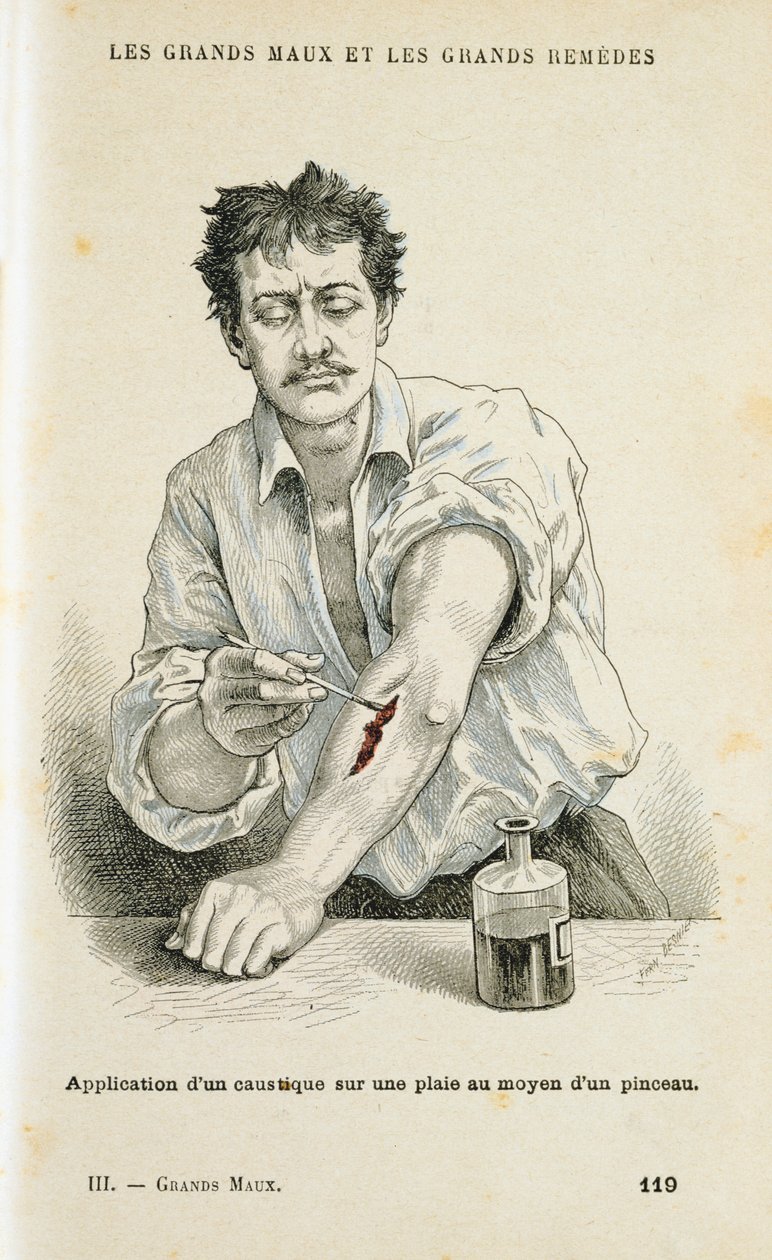 Een wond schilderen met een antiseptische oplossing, ca. 1890 door Unbekannt