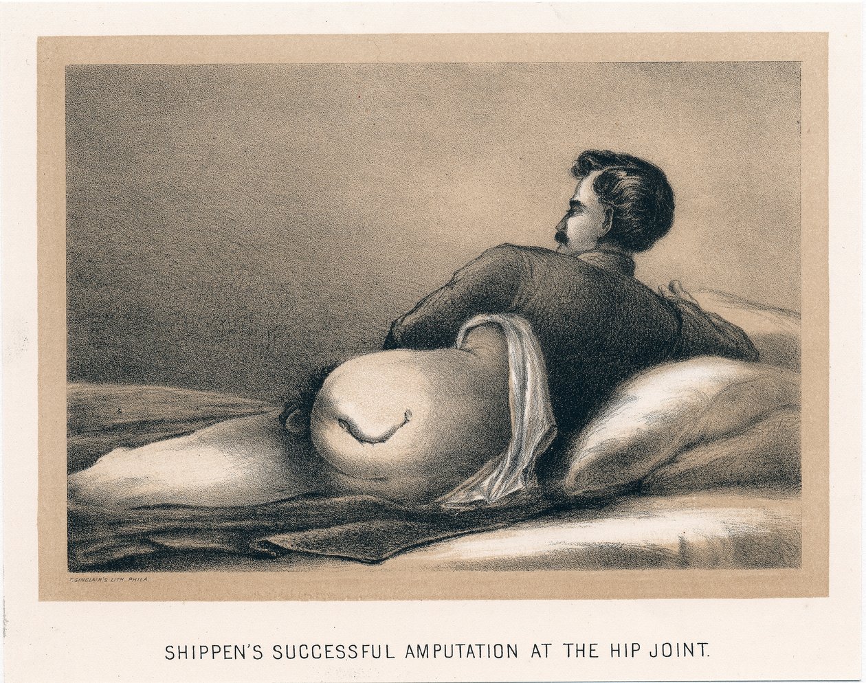 Shippens succesvolle amputatie aan het heupgewricht, Amerikaanse Burgeroorlog, 1865 door Unbekannt