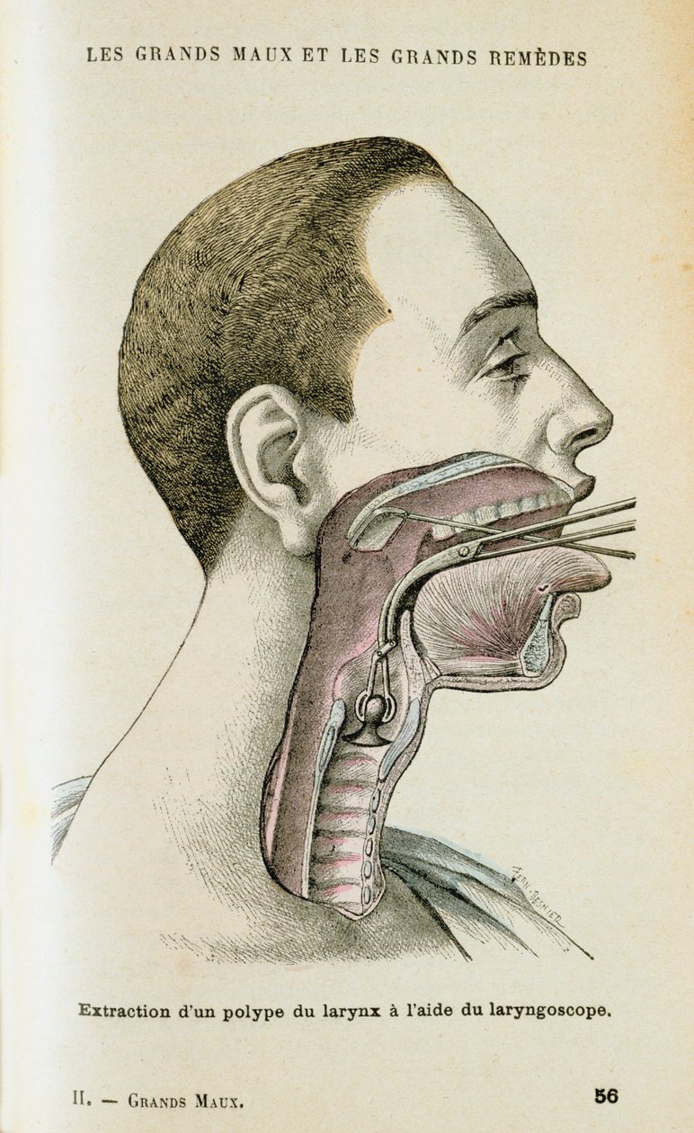 Gebruik van een laryngoscoop om een poliep uit de keel te verwijderen, ca. 1890 door Unbekannt