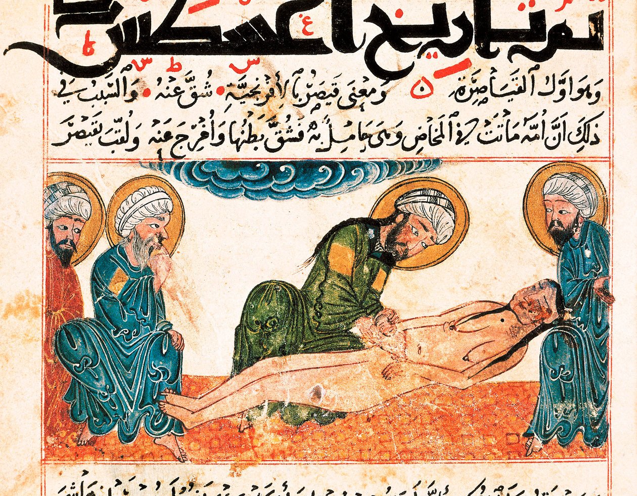 Afbeelding van keizersnede. Miniatuur uit een medisch manuscript van Abu Raihan Al-Biruni (of Alberuni) (973-1048), Perzisch intellectueel en wetenschapper, folio 161. door Unbekannt
