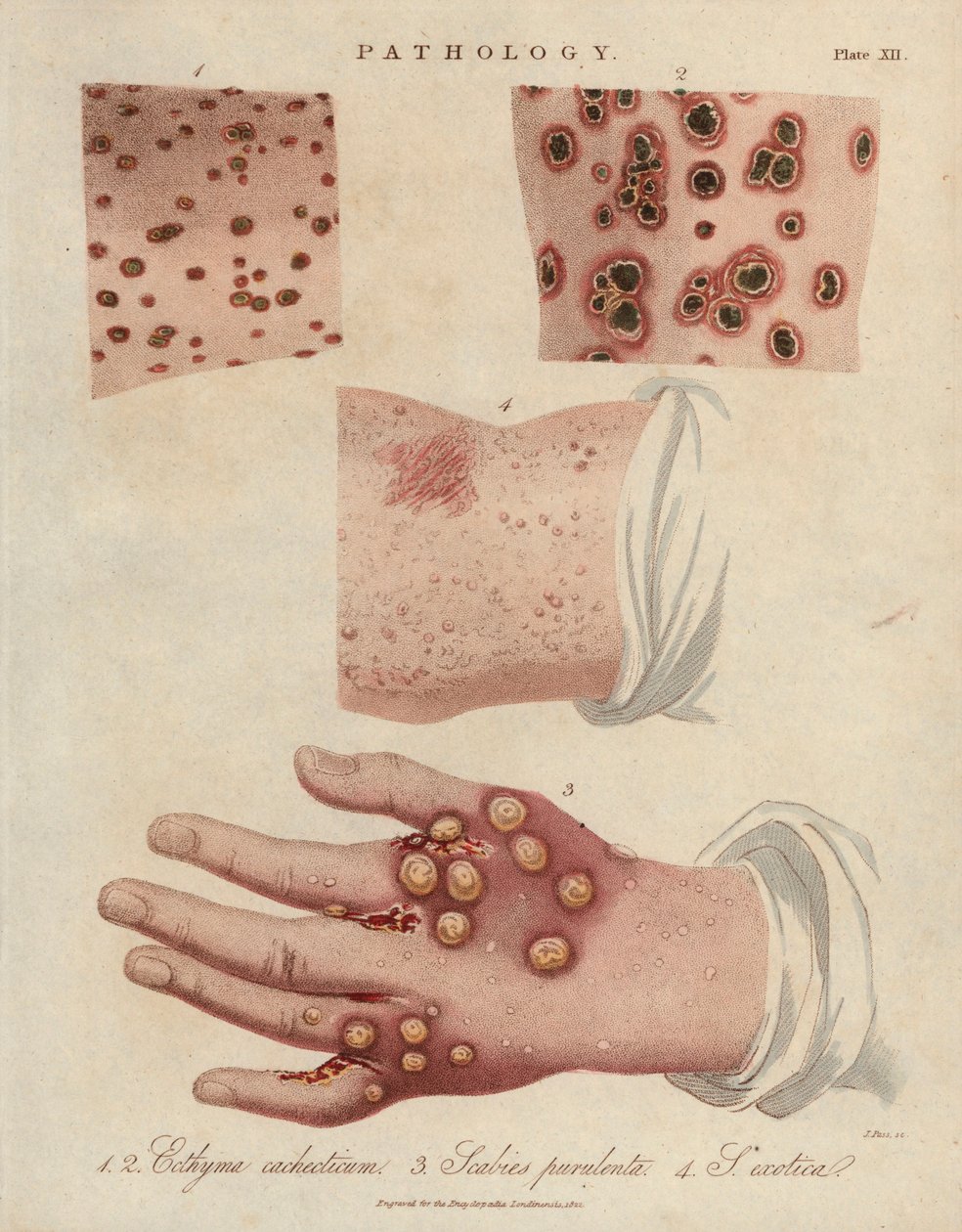 Huidzweer, etterige schurft en schurft veroorzaakt door een scabiei sarcoptische mijt - Lithografie door John Pass, gepubliceerd in Encyclopedia Londinensis door John Wilkes, J.Adlard editie, Londen door Unbekannter Künstler
