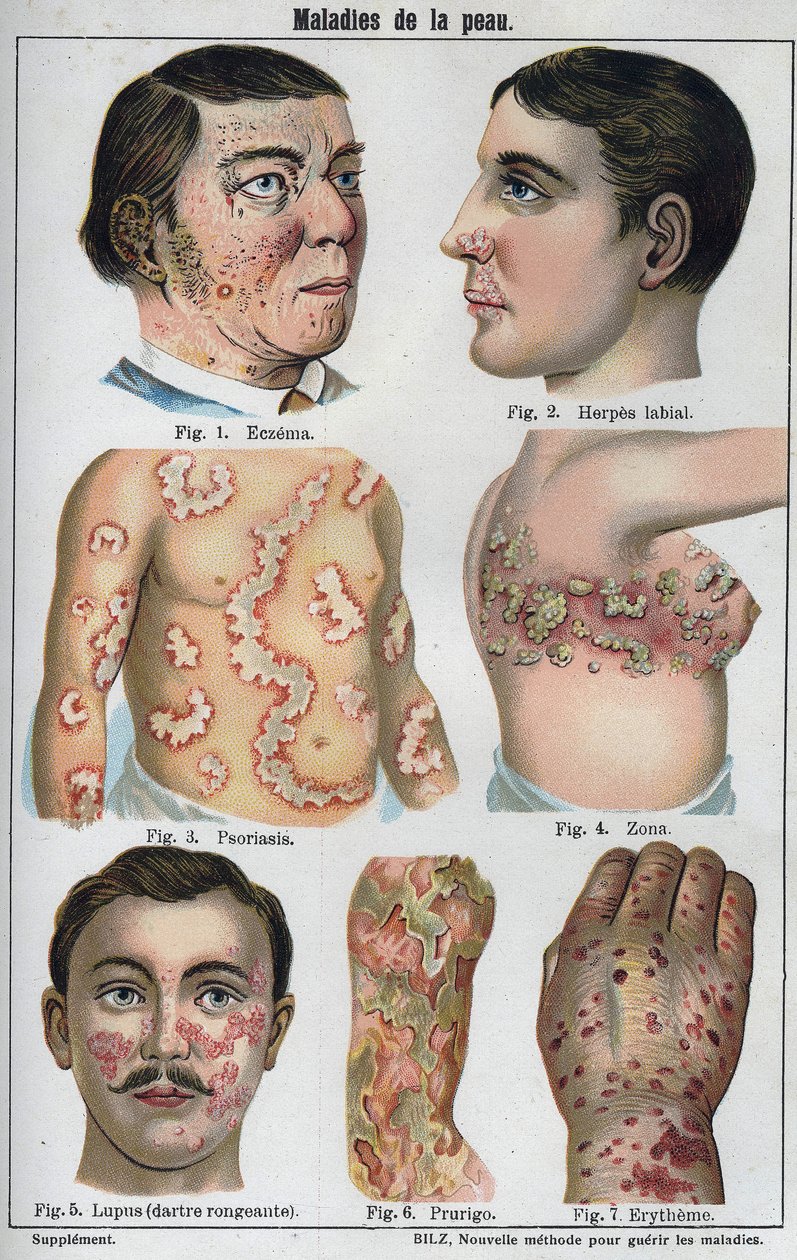 Huidziekten: Eczeem, labiale herpes, psoriasis, gordelroos, lupus (rottende darter), prurigo, erytheem. 