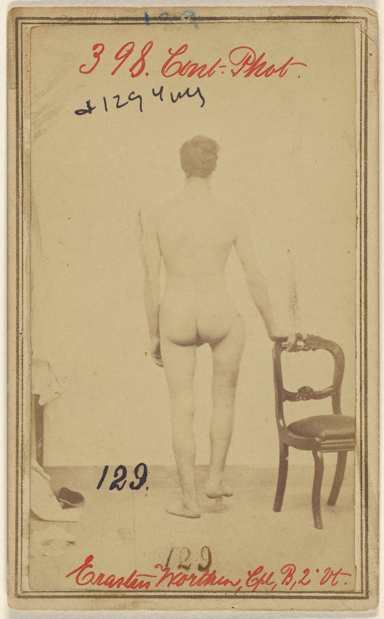Breuk van het bovenste derde deel van het dijbeen. Erastus Worthen, Corp Co. B. 2nd Vermont Vols. 25 jaar oud - Woonplaats Stockbridge VT. door Unknown artist