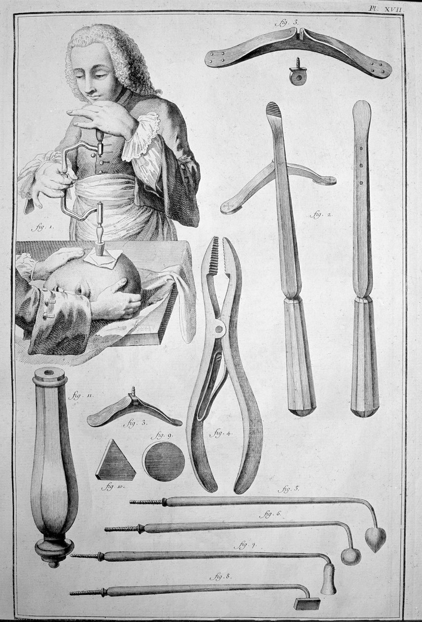 Schedeltrepanatie, diverse instrumenten door Unknown artist