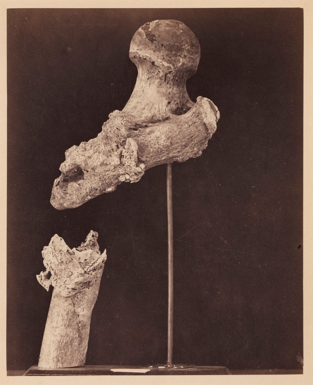 Luitenant Goodwin, overleden, eenzijdige schotbreuk van het bovenste derde deel van de rechter dijbeen, zeven maanden na de verwonding, uit de fotocatalogus van de chirurgische afdeling door William Bell