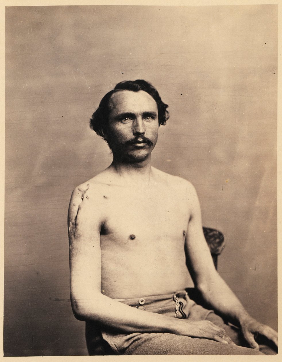 Soldaat Adolph Zirsse, Geslaagde intermediaire excisie van de kop en twee en een halve centimeter van de schacht van de rechter Humerus, uit de fotocatalogus van de chirurgische afdeling door William Bell