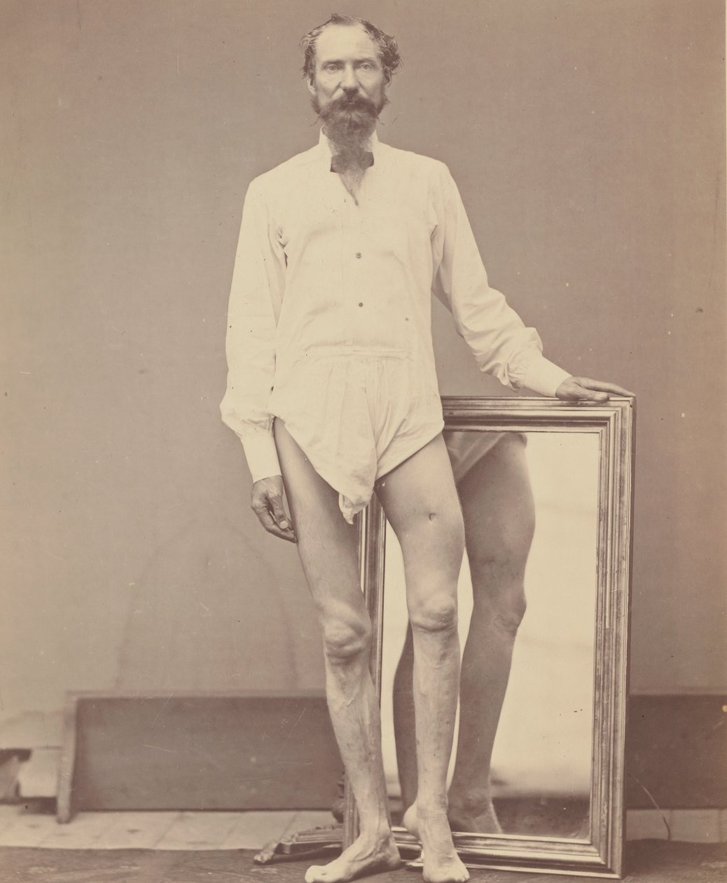 Schotwond van het Middelste Derde van het Linker Dijbeen, 1865-67 door William H. Bell