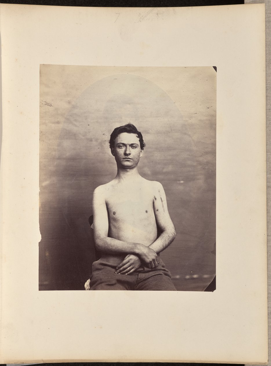 Herstel na excisie van de kop van de linker humerus voor schotwondfractuur door William H. Bell