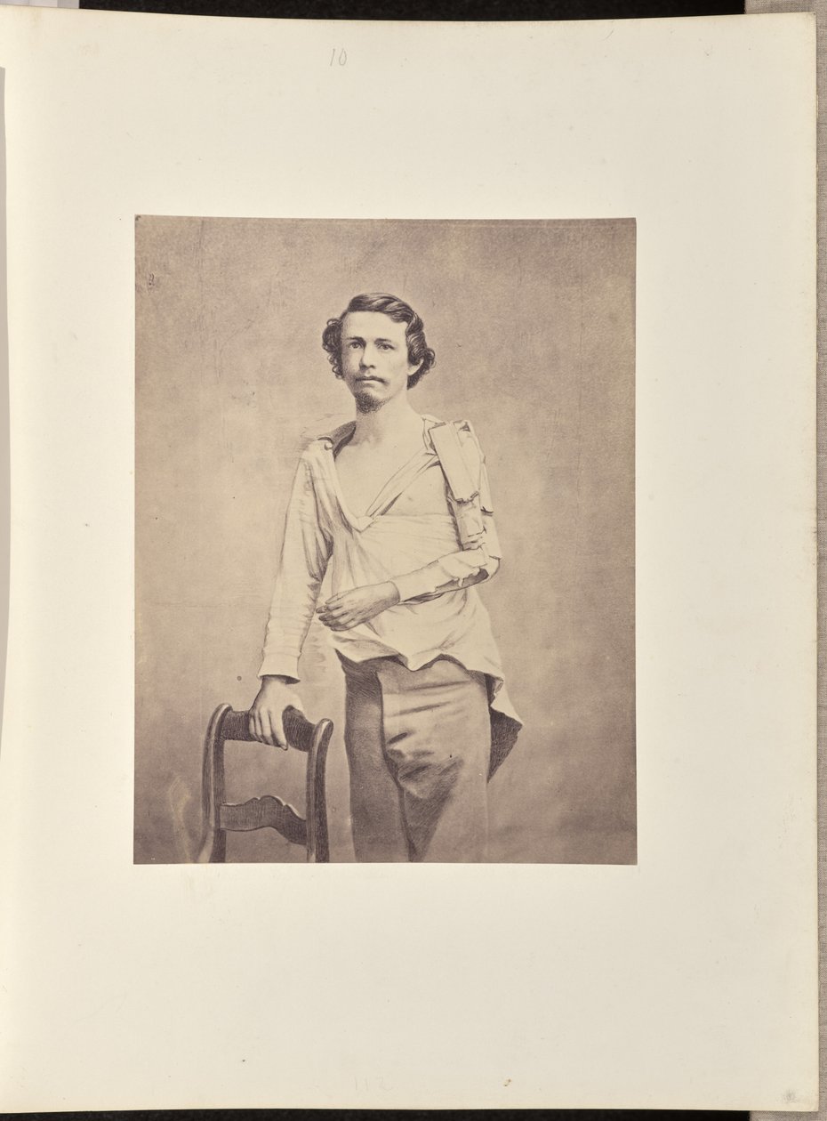 Succesvolle excisie van de kop van de linker humerus, gevolgd door necrose en secundaire excisie van de rest van de humerus en de bovenste extremiteiten van de radius en ulna door William H. Bell