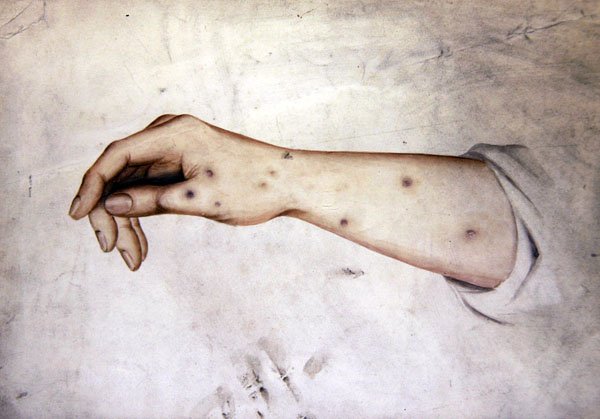 Studie van een Onderarm met Huidconditie, ca. 1850 door William Lover