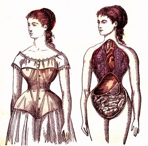 Korsetcompressie - Normaal leven en gezondheid door J. Rengade. Tekening door A. Demarle 1881