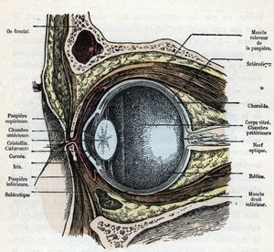 Verticale doorsnede van een oogbal met cataract Gravure uit 