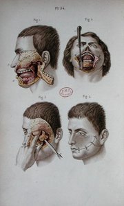 Anatomische plaat van de bovenkaak