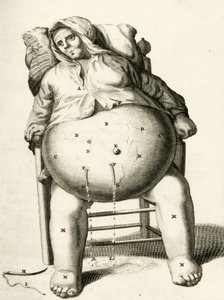 Aftappen van vocht uit een abces, uit Exercitationes Practicae circa Medendi Methodum door Frederik Dekkers, 1694 door Dutch School