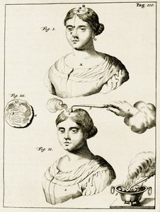 Behandeling van een epilepsiepatiënt, uit Exercitationes Practicae circa Medendi Methodum door Frederik Dekkers, 1694 door Dutch School