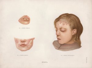 Huidaandoeningen: Herpes